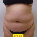 Liposuction Before & After Patient #341
