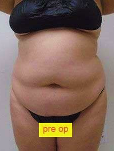 Liposuction Before & After Patient #341