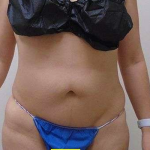 Liposuction Before & After Patient #344