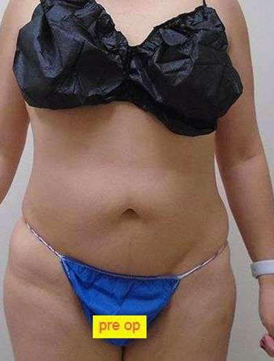 Liposuction Before & After Patient #344