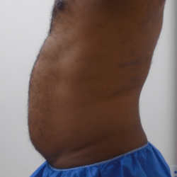 Liposuction Before & After Patient #347