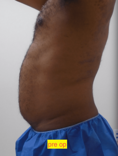 Liposuction Before & After Patient #347
