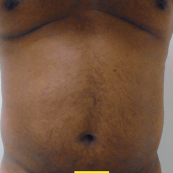 Liposuction Before & After Patient #350