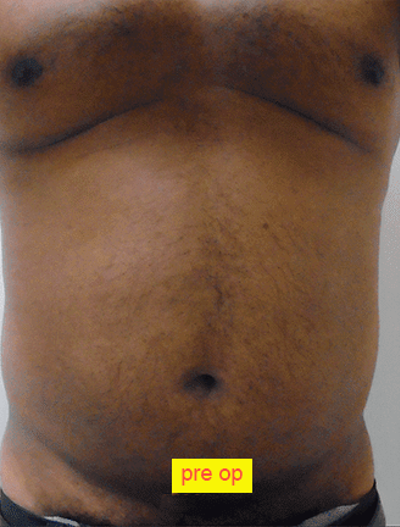 Liposuction Before & After Patient #350