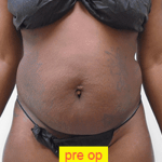 Liposuction Before & After Patient #353