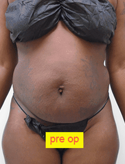 Liposuction Before & After Patient #353