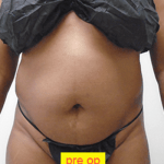Liposuction Before & After Patient #356