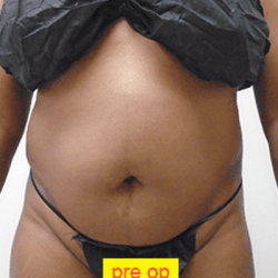 Liposuction Before & After Patient #356