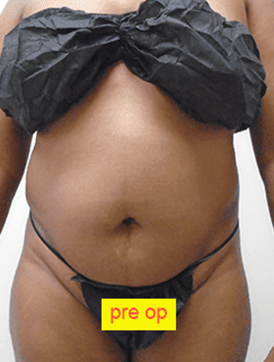 Liposuction Before & After Patient #356