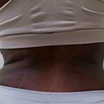 Middle Back Before & After Patient #365