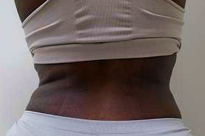 Middle Back Before & After Patient #365