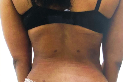 Middle Back Before & After Patient #368