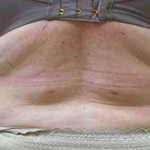 Middle Back Before & After Patient #362