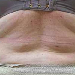 Middle Back Before & After Patient #362