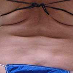 Middle Back Before & After Patient #362