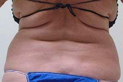 Middle Back Before & After Patient #362