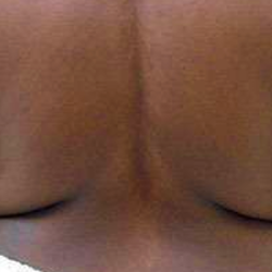 Middle Back Before & After Patient #365