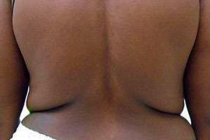 Middle Back Before & After Patient #365