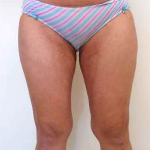 Outer Thigh Before & After Patient #371