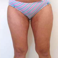 Outer Thigh Before & After Patient #371