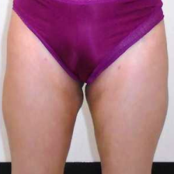Outer Thigh Before & After Patient #377