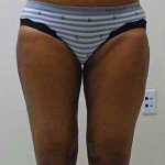 Outer Thigh Before & After Patient #378