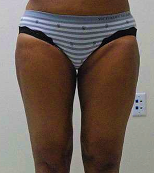 Outer Thigh Before & After Patient #378
