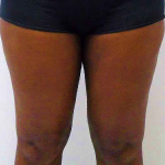 Outer Thigh Before & After Patient #381