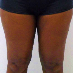 Outer Thigh Before & After Patient #381