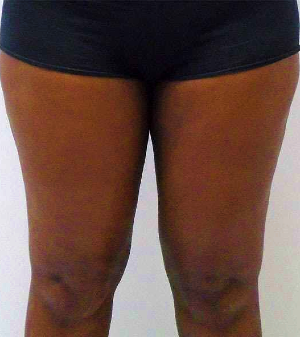 Outer Thigh Before & After Patient #381