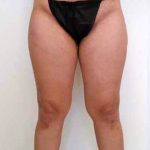 Outer Thigh Before & After Patient #371