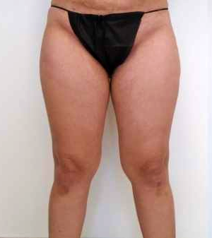 Outer Thigh Before & After Patient #371
