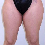 Outer Thigh Before & After Patient #377