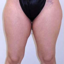 Outer Thigh Before & After Patient #377