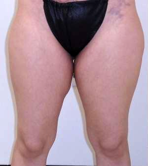 Outer Thigh Before & After Patient #377