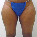 Outer Thigh Before & After Patient #378