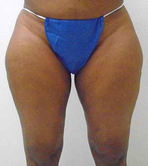 Outer Thigh Before & After Patient #378
