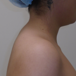 Liposuction Before & After Patient #919