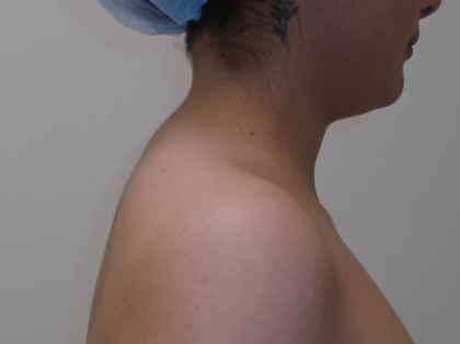 Liposuction Before & After Patient #919