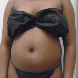 Lipo 360 Before & After Patient #914
