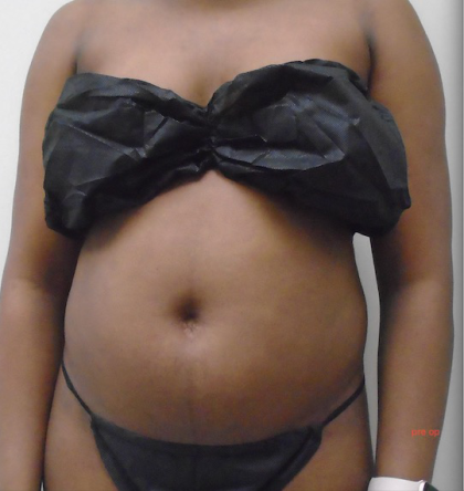 Lipo 360 Before & After Patient #914