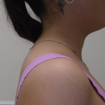 Liposuction Before & After Patient #919