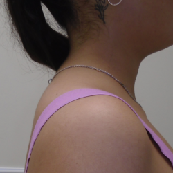 Liposuction Before & After Patient #919