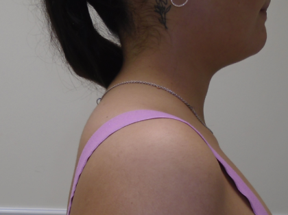 Liposuction Before & After Patient #919