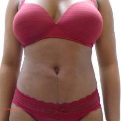 Lipo 360 Before & After Patient #914