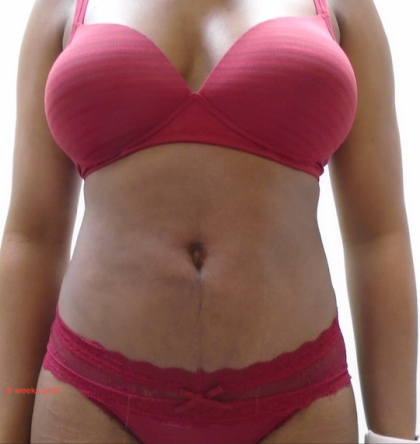 Lipo 360 Before & After Patient #914