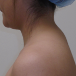 Liposuction Before & After Patient #919