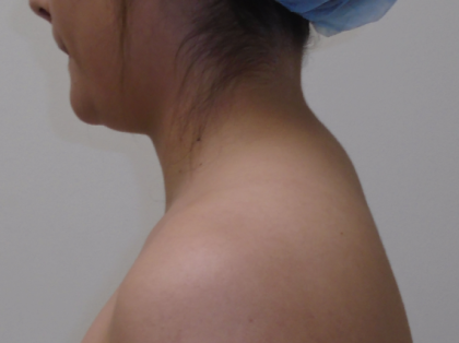Liposuction Before & After Patient #919
