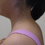 Liposuction Before & After Patient #919