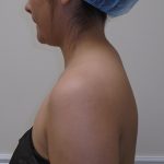 Buffalo Hump Liposuction Before & After Patient #993